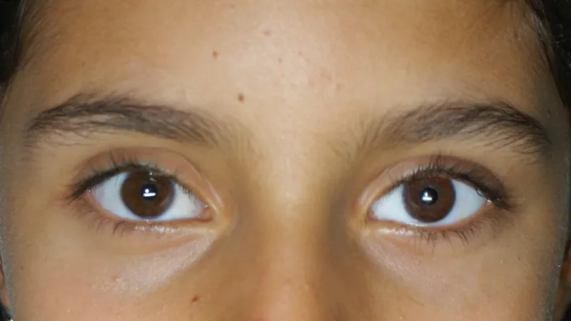 Gm Oculariste Prothese De Loeil Lyon Exemples Protheses Oculaires Enfants 10