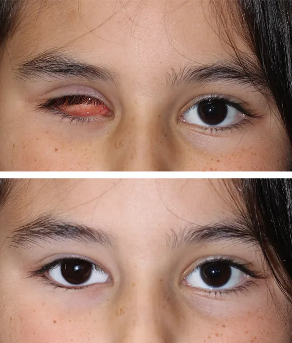 Gm Oculariste Prothese De Loeil Lyon Exemples Protheses Oculaires Enfants 12