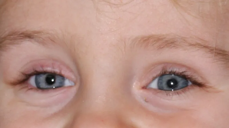 Gm Oculariste Prothese De Loeil Lyon Exemples Protheses Oculaires Enfants 13