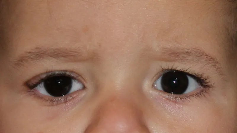 Gm Oculariste Prothese De Loeil Lyon Exemples Protheses Oculaires Enfants 3