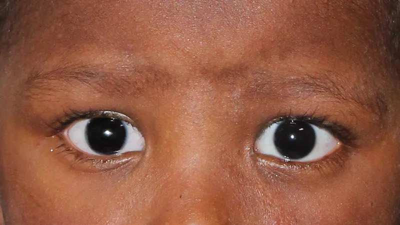 Gm Oculariste Prothese De Loeil Lyon Exemples Protheses Oculaires Enfants 4