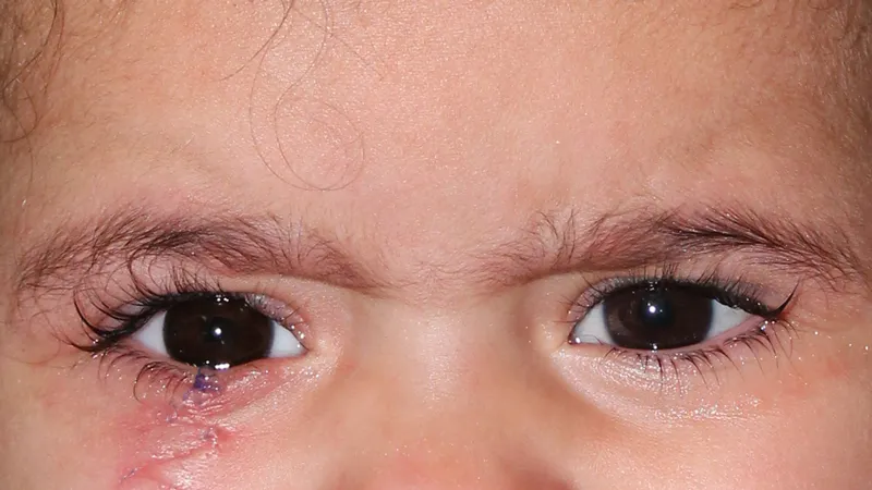Gm Oculariste Prothese De Loeil Lyon Exemples Protheses Oculaires Enfants 5
