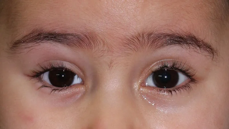 Gm Oculariste Prothese De Loeil Lyon Exemples Protheses Oculaires Enfants 6
