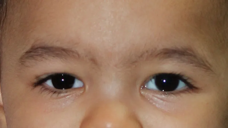 Gm Oculariste Prothese De Loeil Lyon Exemples Protheses Oculaires Enfants 7 1