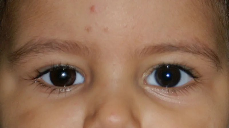 Gm Oculariste Prothese De Loeil Lyon Exemples Protheses Oculaires Enfants 8