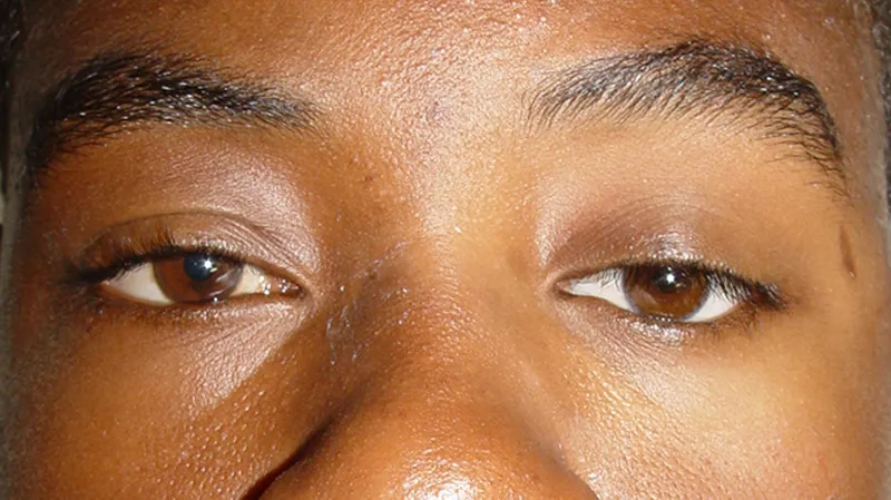 Gm Oculariste Prothese De Loeil Lyon Exemples Protheses Oculaires Enfants 9